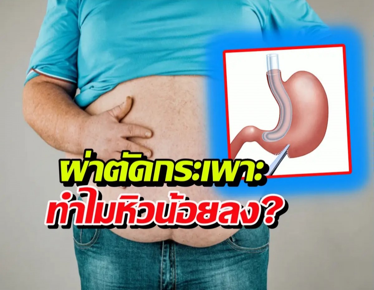 ทำไมผ่าตัดกระเพาะ กินน้อย แต่ไม่เกิดโยโย่